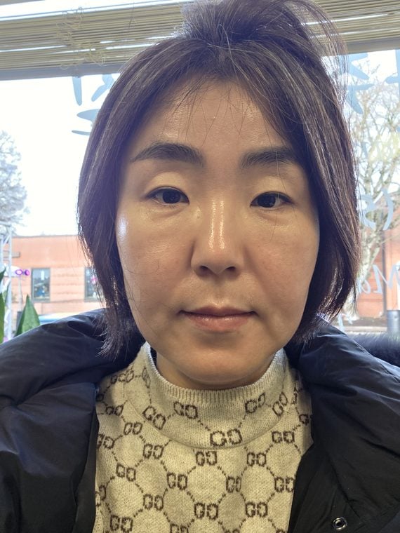 Example before photo: face straight on to the camera in even daylight, clean face, plain background.